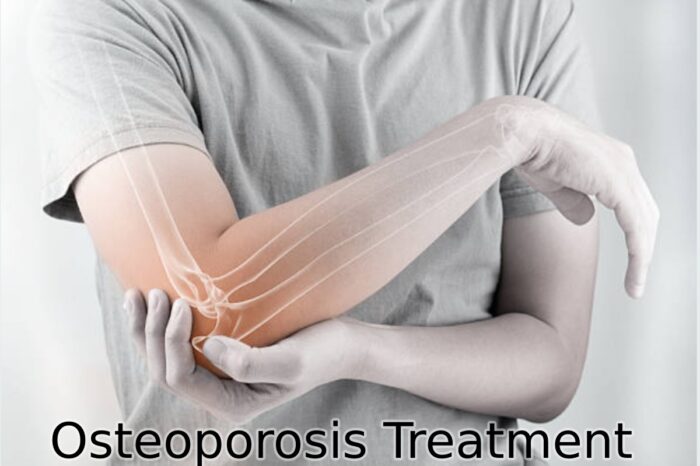 Osteoporosis Treatment